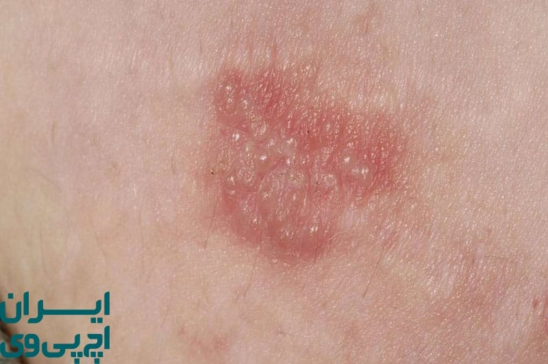 عوارض جسمی درمان‌ نکردن تبخال تناسلی