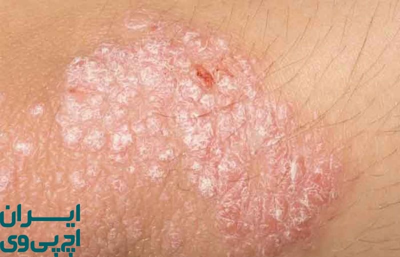 عوارض نادر اما مهم درمان‌ نکردن تبخال تناسلی