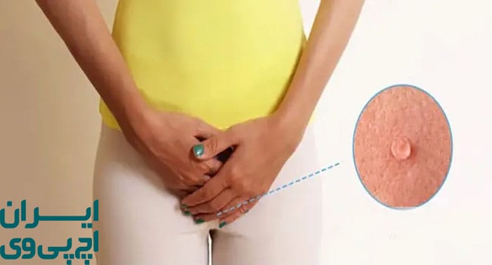 لیزر زگیل تناسلی چیست و چگونه انجام می‌شود؟