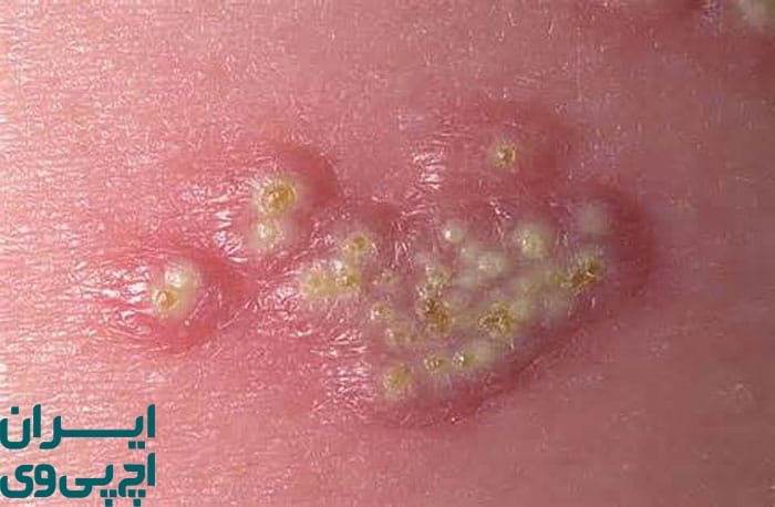 ماهیت ویروس تبخال تناسلی