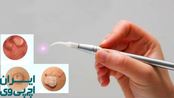 مزایای کلیدی در درمان زگیل تناسلی مردان