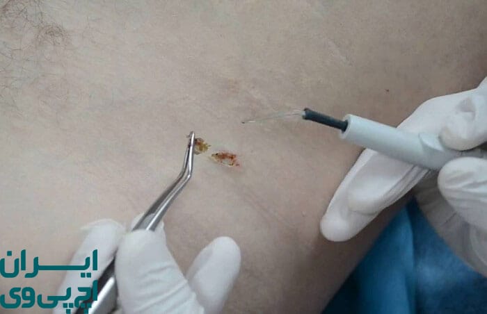 مقایسه عملکرد روش‌های درمان کلاسیک و جدید HPV 