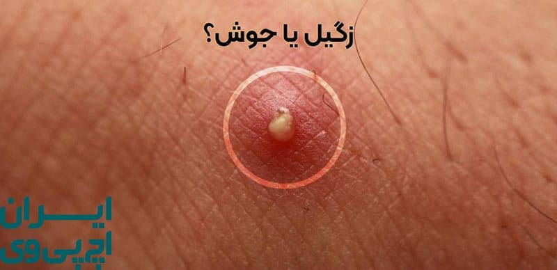 مقایسه کلی جوش و زگیل تناسلی