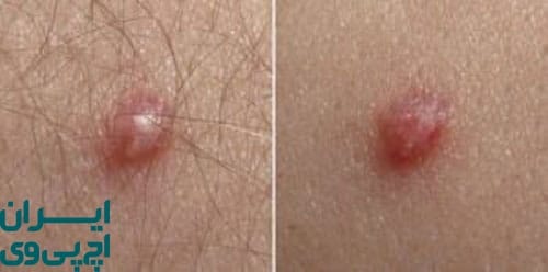 منشأ زگیل تناسلی یا جوش چیست؟