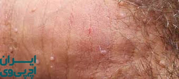 نحوه انتقال تبخال تناسلی