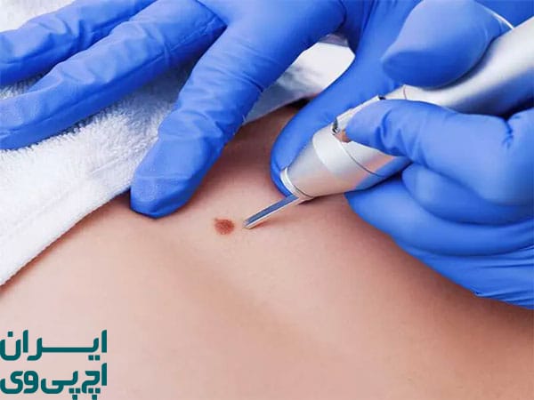 نکات مهم برای موفقیت کامل درمان زگیل تناسلی با لیزر