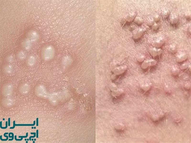 نکات مهم هنگام استفاده از پمادهای درمان زگیل تناسلی مردان