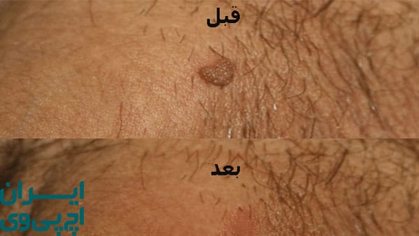 هزینه درمان HPV با لیزر 