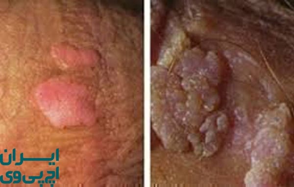 ویروس HPV چگونه در بدن پخش می‌شود؟