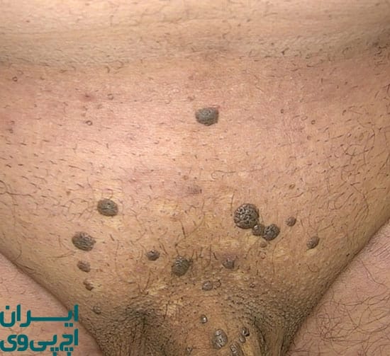 ویروس HPV چگونه کار می‌کند؟