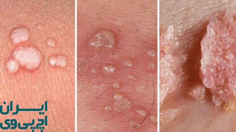 ویژگی‌های یک دکتر خوب برای درمان زگیل تناسلی