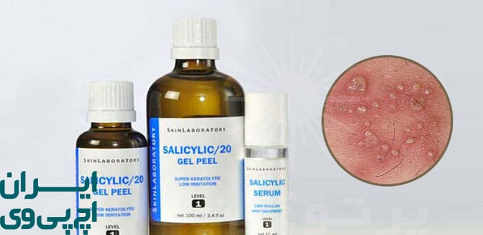 چرا درمان زگیل باید سریع و کامل باشد؟