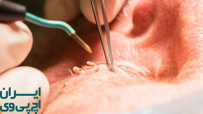 چرا درمان زگیل تناسلی در مردان اهمیت دارد؟