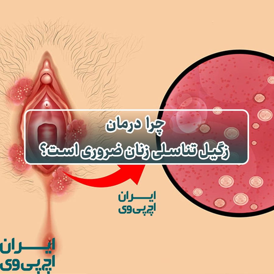 چرا درمان زگیل تناسلی زنان ضروری است؟