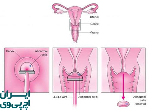 چرا درمان زگیل داخل واژن حساس‌تر از زگیل‌های خارجی است؟