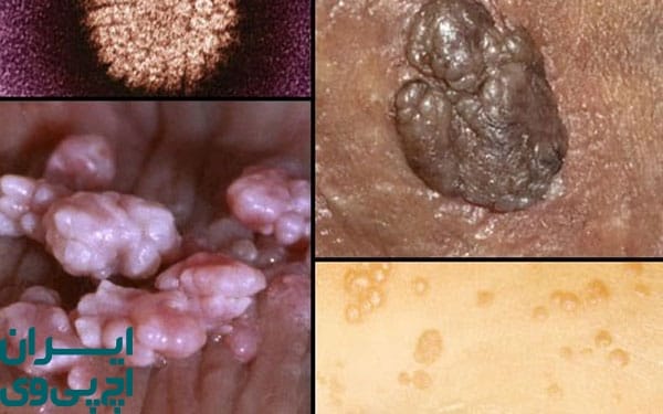 چرا درمان نادرست گیاهی HPV خطرناک است؟