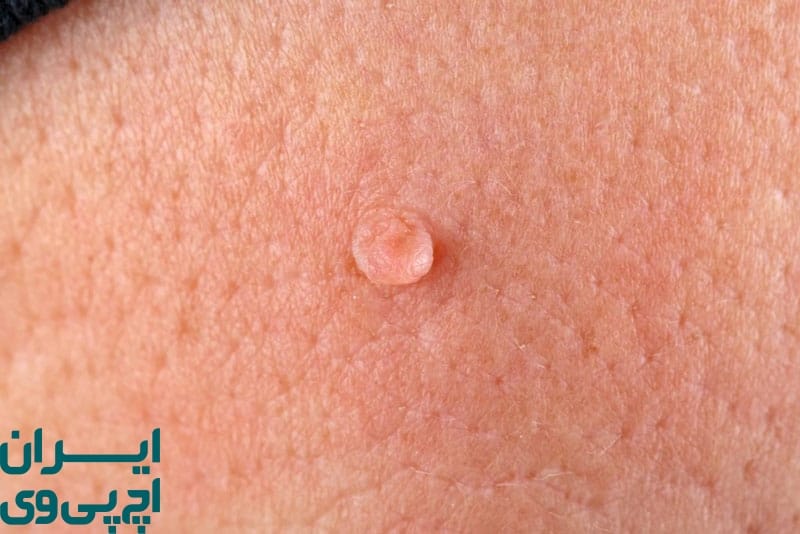 چطور از انتقال شایع HPV جلوگیری کنیم؟