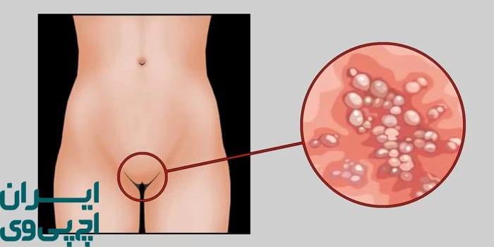 چه زمانی برای درمان سریع تبخال تناسلی زنان به پزشک مراجعه کرد؟