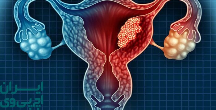 چه عواملی در انتخاب روش درمان زگیل مؤثر هستند؟