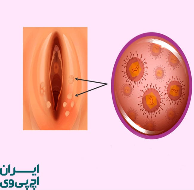 گسترش زگیل‌ها در نواحی مختلف بانوان