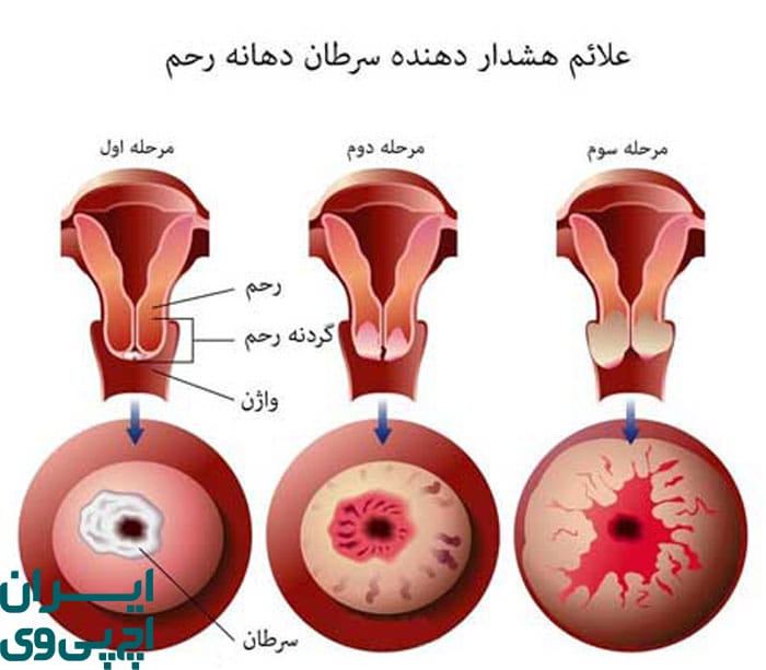 HPV و سرطان دهانه رحم