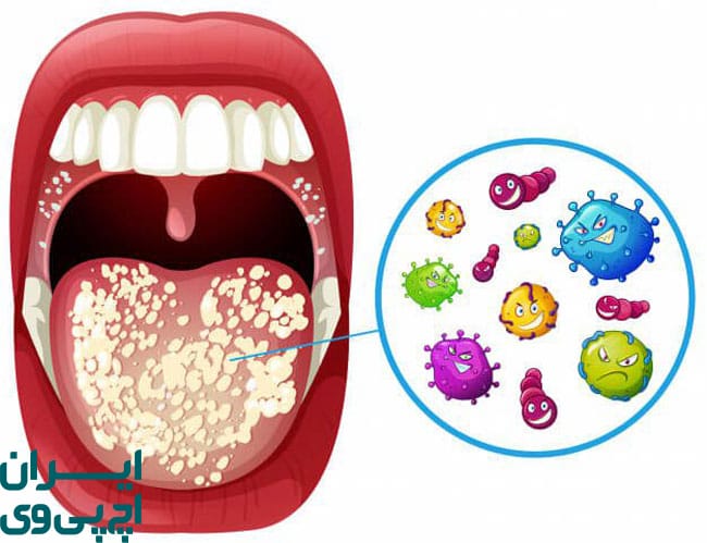آیا باید از بوسیدن شریک مبتلا به HPV اجتناب کرد؟