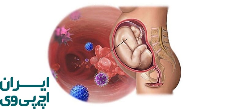 آیا زایمان طبیعی با وجود HPV امکان‌پذیر است؟