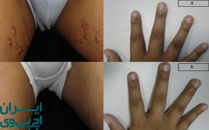 اثربخشی درمان HPV با کرم‌ های موضعی