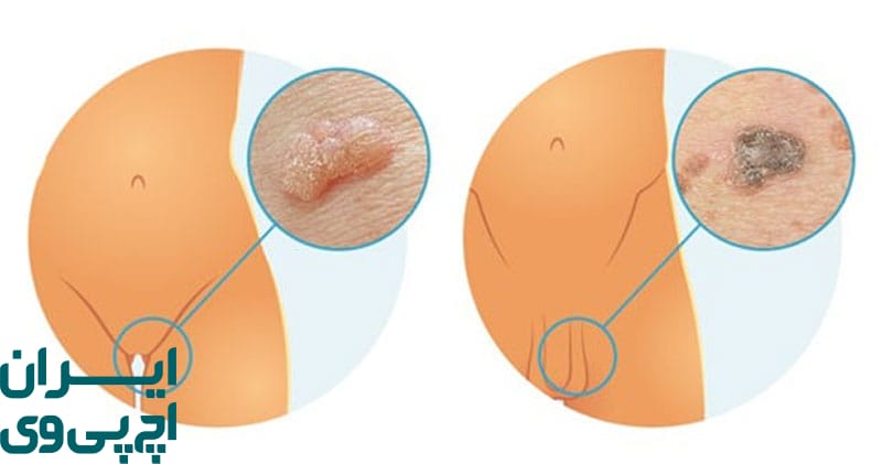 انتقال HPV از طریق تماس پوستی