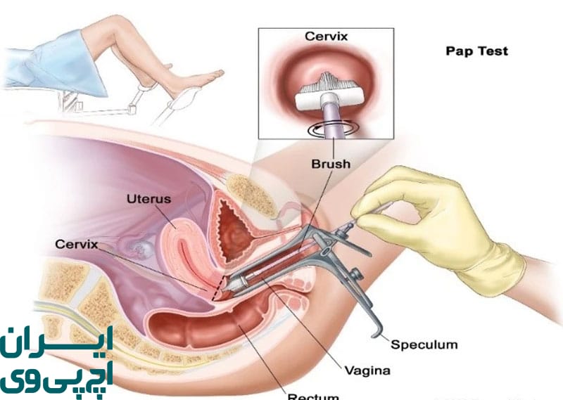 انجام غربالگری منظم HPV