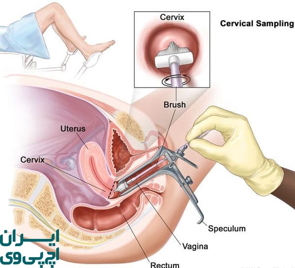 تست HPV RNA و بررسی فعالیت ویروسی