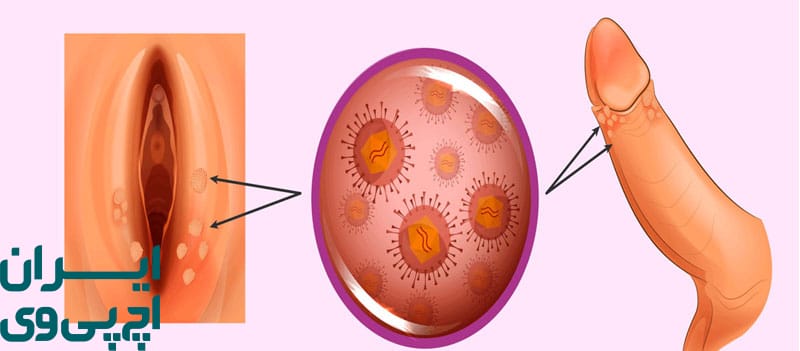 تغییر در ترشحات واژن یا بوی غیرعادی در زنان یکی از علائم HPV