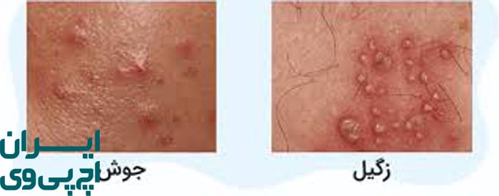 تفاوت HPV با آکنه‌ تناسلی