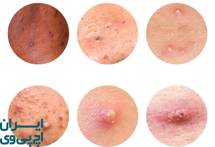 تفاوت HPV با آکنه‌ تناسلی در مدت‌ زمان باقی ماندن ضایعه 