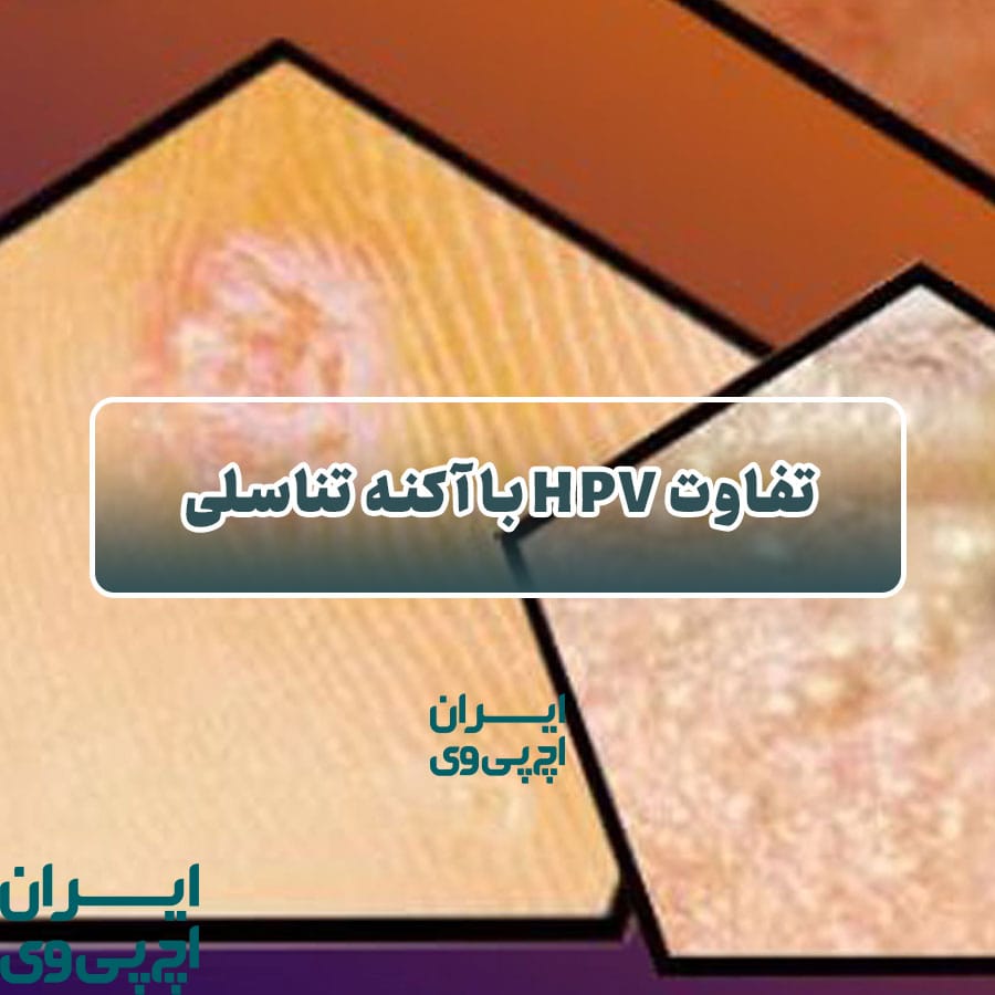 تفاوت HPV با آکنه‌ تناسلی