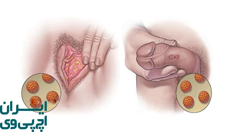 تفاوت HPV با بیماری‌ های مقاربتی