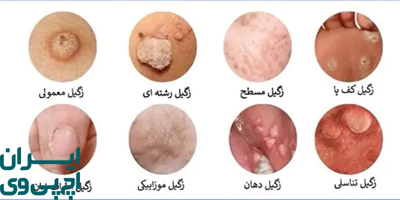 تفاوت ظاهری زگیل‌ های HPV و غیر HPV