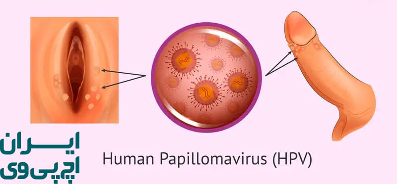 جلوگیری از بارداری در زمان بیماری HPV