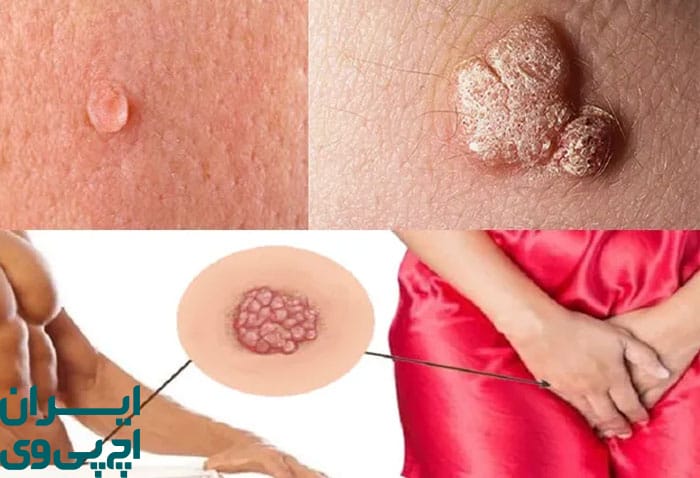 خارش و تحریک مکرر ناحیه تناسلی علائم اولیه HPV در مردان