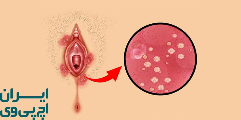 درمان ترکیبی HPV در پوست‌های حساس