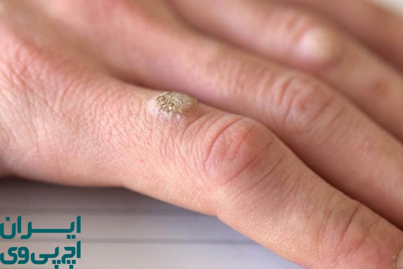 درمان دارویی خانگی و موضعی برای زگیل‌های غیر تناسلی