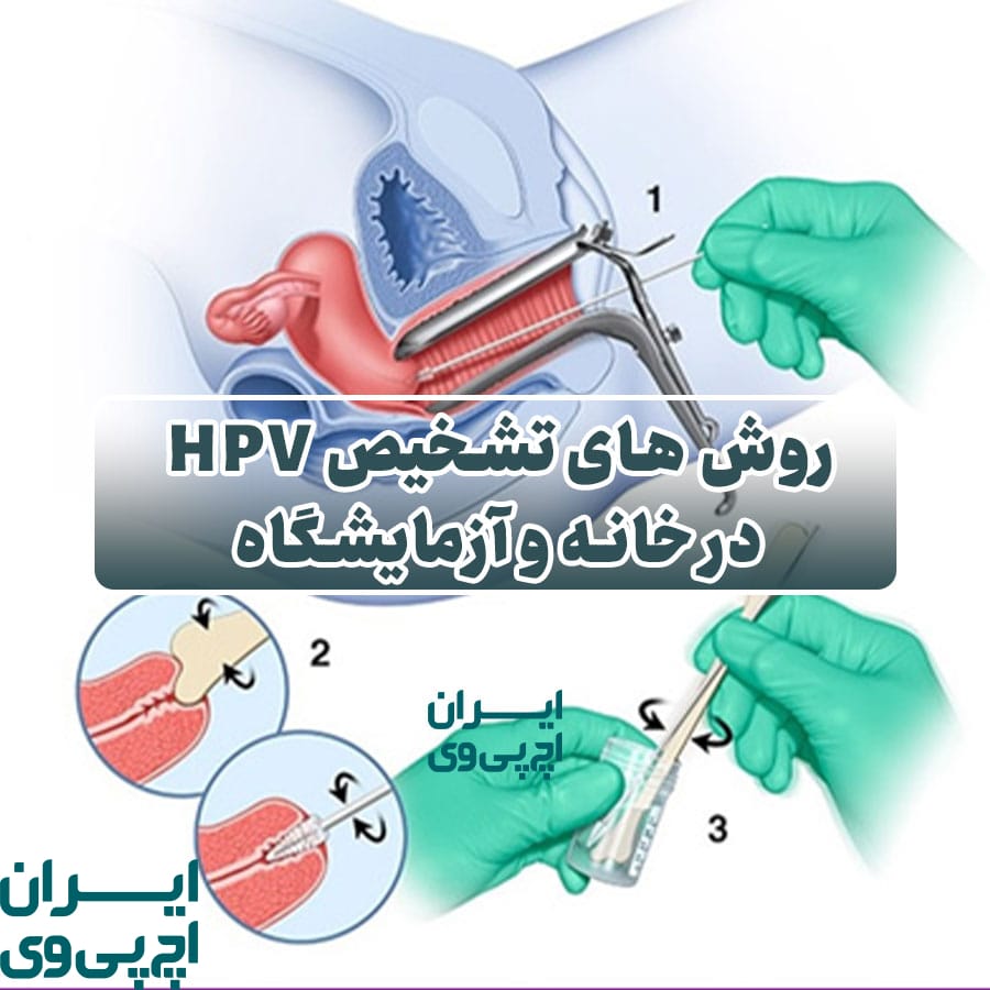 روش‌ های تشخیص HPV در خانه و آزمایشگاه