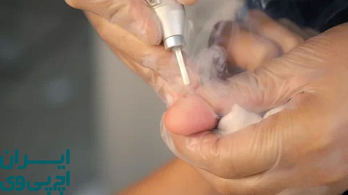 روش‌های درمان HPV در پوست‌های حساس