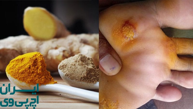 زردچوبه و ماده فعال کورکومین ضدالتهاب قوی برای مهار HPV