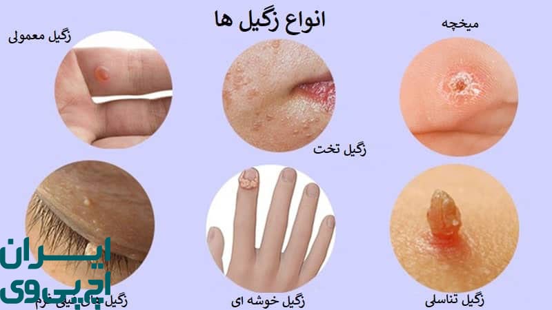 زگیل HPV در نواحی غیر تناسلی