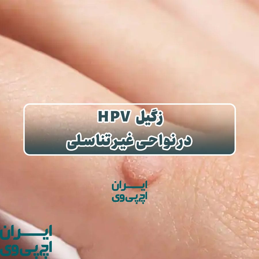 زگیل HPV در نواحی غیر تناسلی