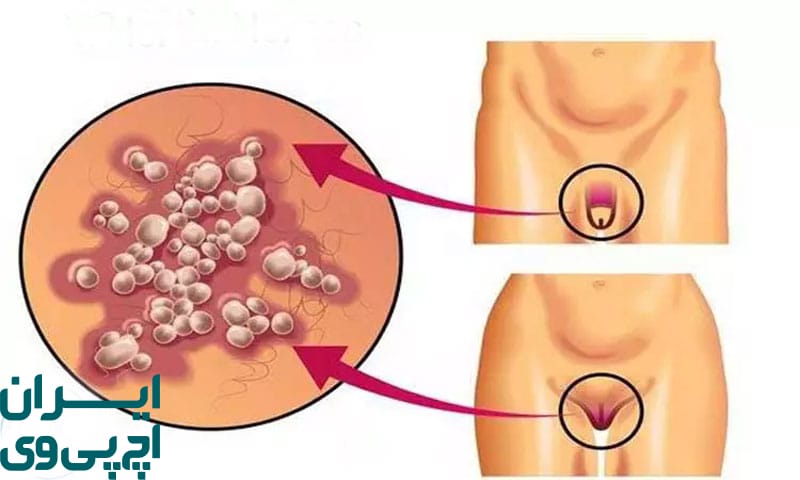 شایع‌ ترین علائم زگیل‌ های تناسلی اولیه در مردان و زنان