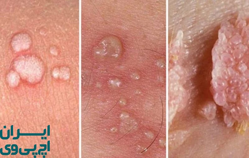 ظاهر شدن زگیل تناسلی یا ضایعات پوستی غیر عادی
