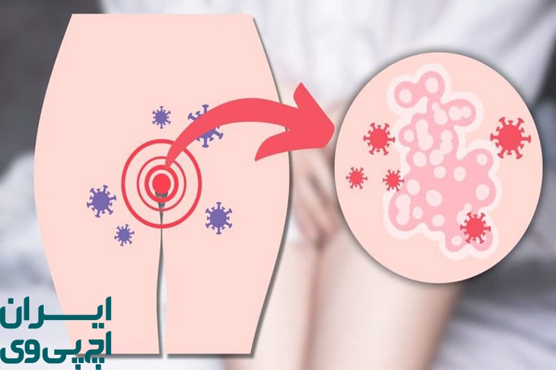 عملکرد ژل‌ های ضد عفونی در ناحیه تناسلی برای HPV