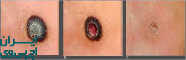 لیزر درمانی HPV با شدت پایین مخصوص پوست‌های حساس